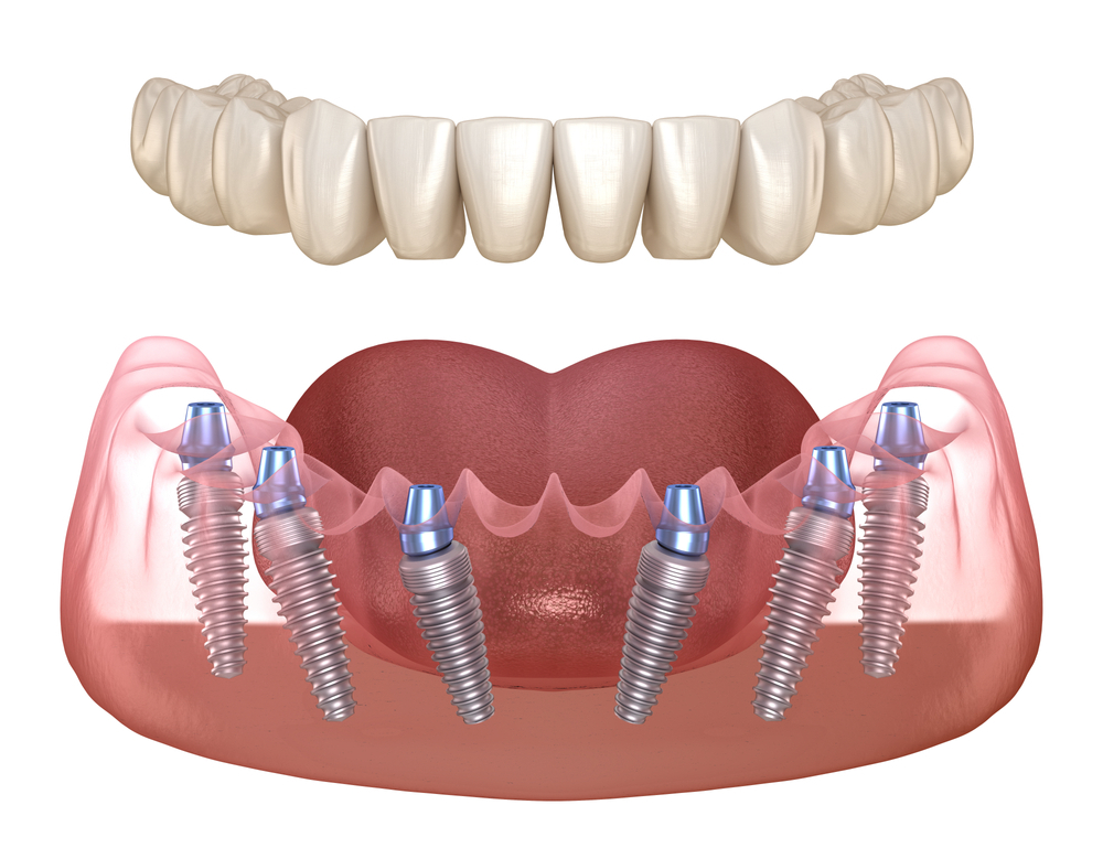 implant dentar - times dent