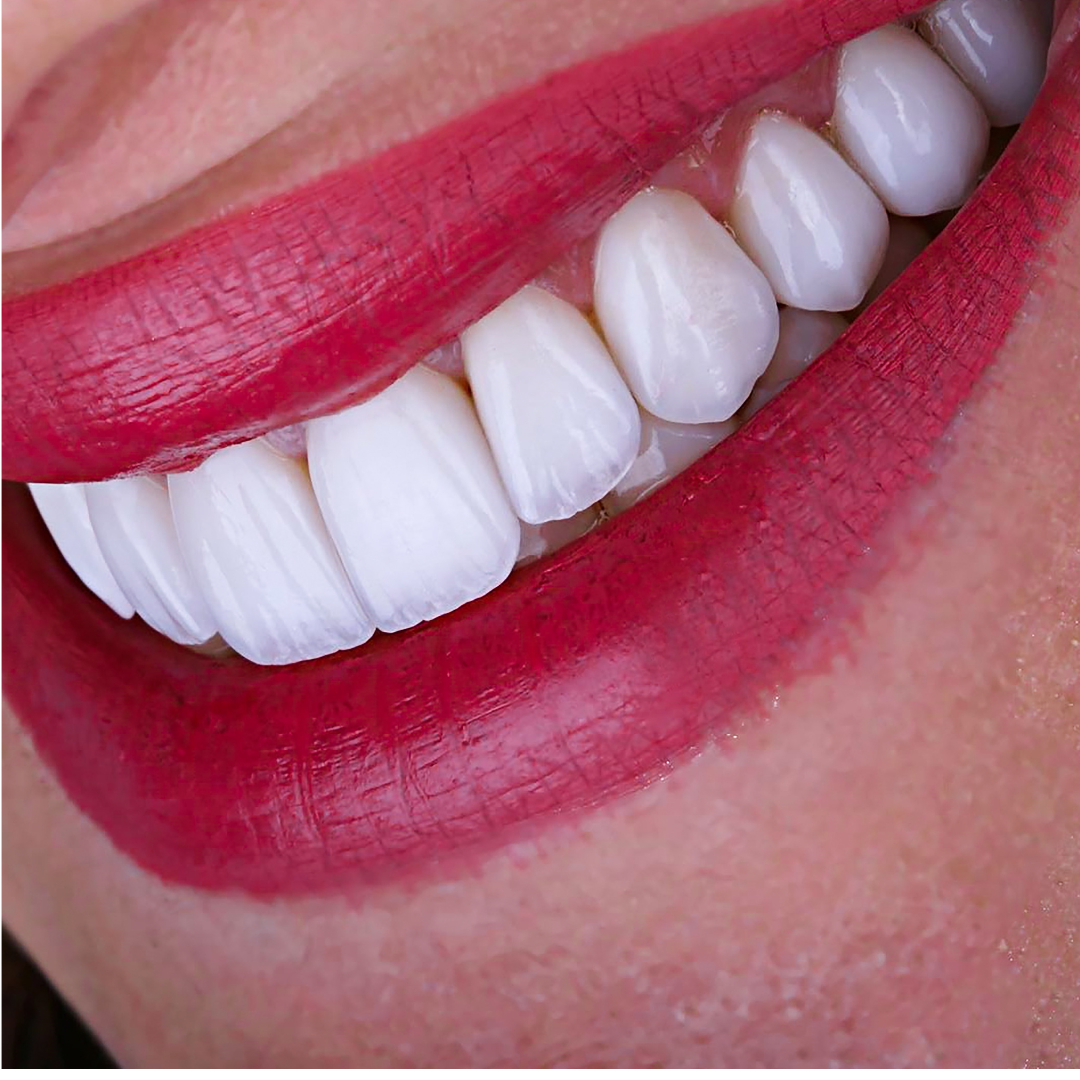 Fatetare dentara - Times Dent