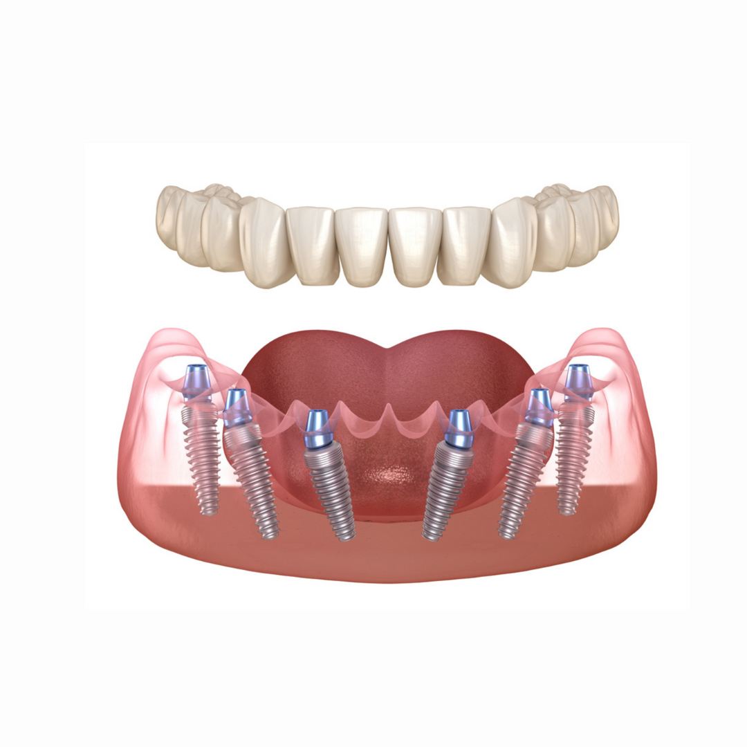 Protetica pe implant - Times Dent