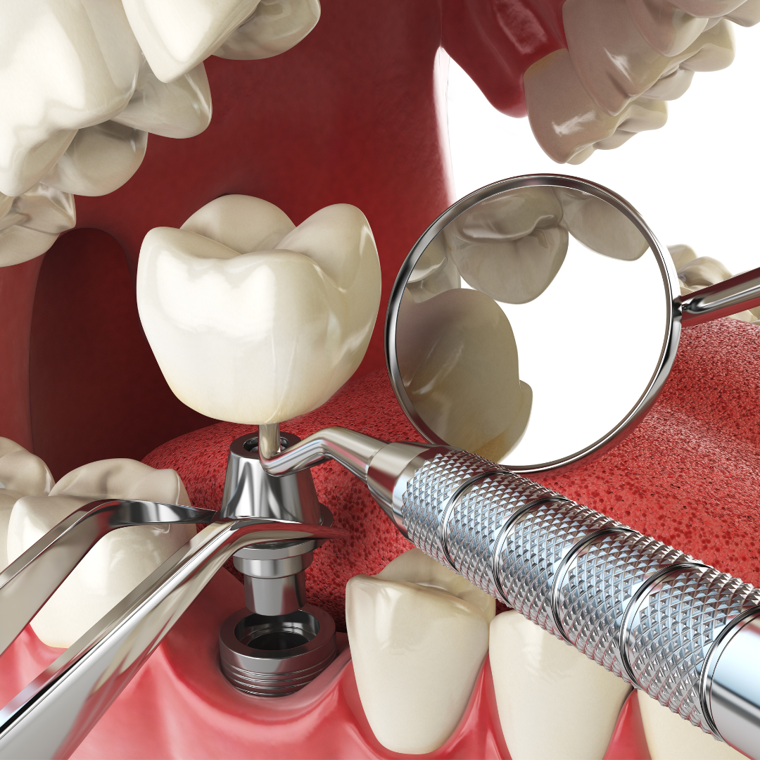 Implant dentar - Times Dent
